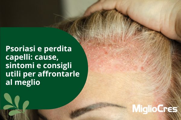 Psoriasi e perdita capelli: cause, sintomi e consigli utili per affrontarle al meglio 